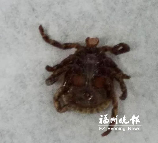 女孩爬山归来腿上长“痣”竟是蜱虫　应尽快就医