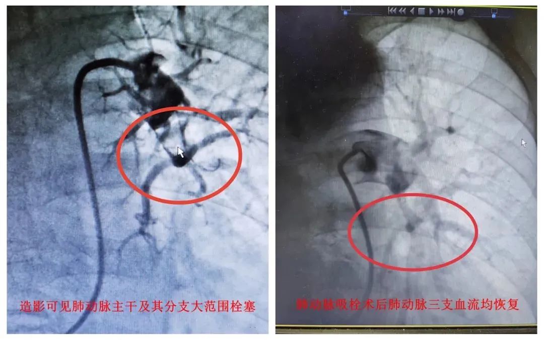 “阳”后一个月，这类风险增加33倍！