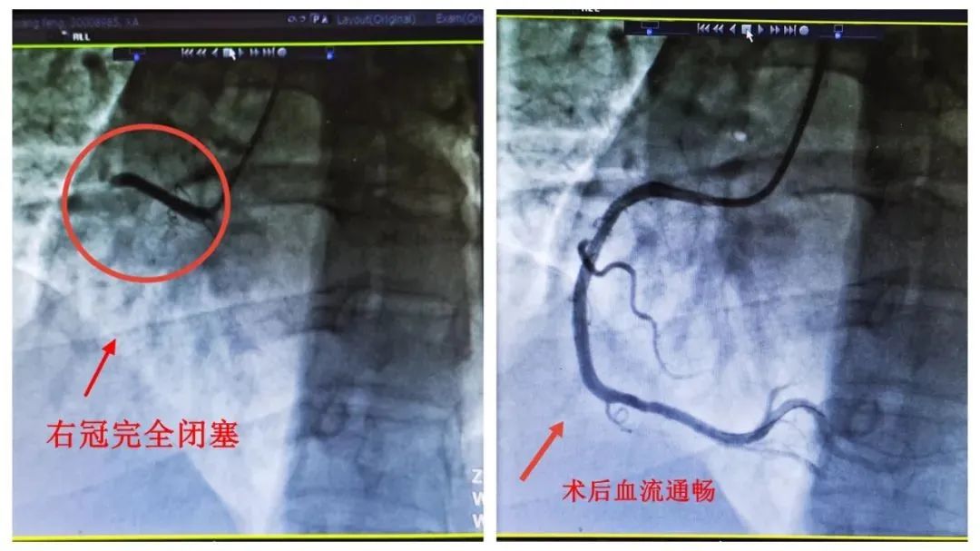 “阳”后一个月，这类风险增加33倍！