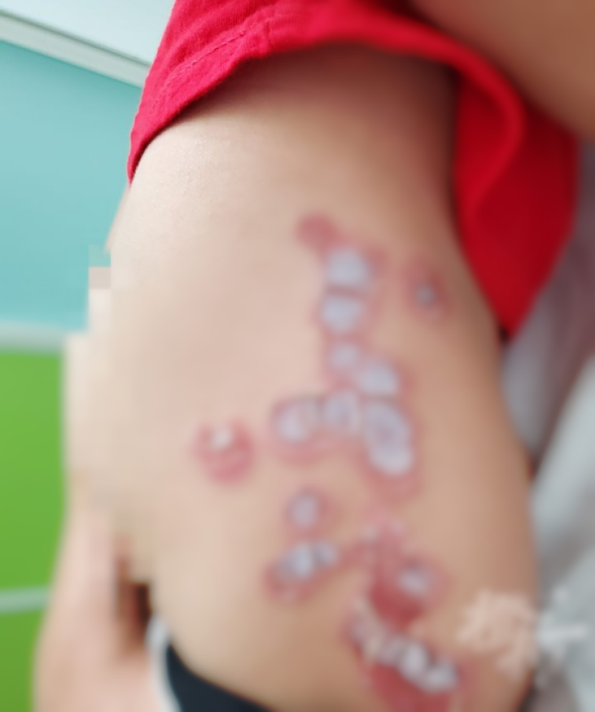 3岁孩子皮肤溃烂！一经接触就会传染……紧急提醒！